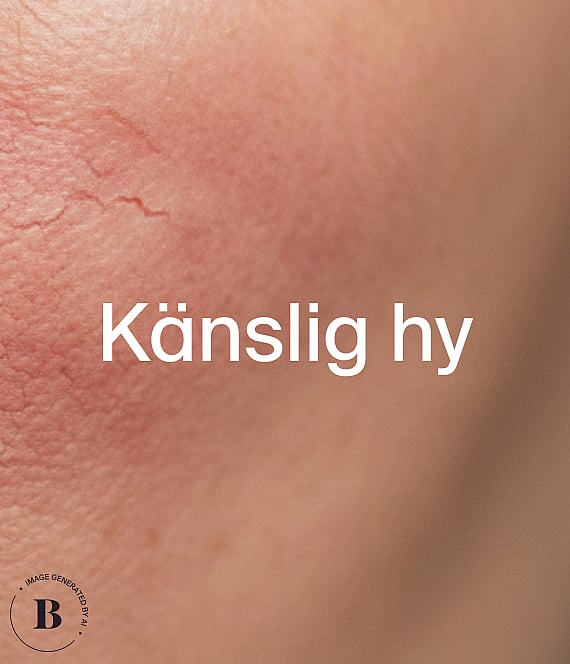 Närbild av rödaktig hud med fina röda blodkärl. Vit text "Känslig hy".